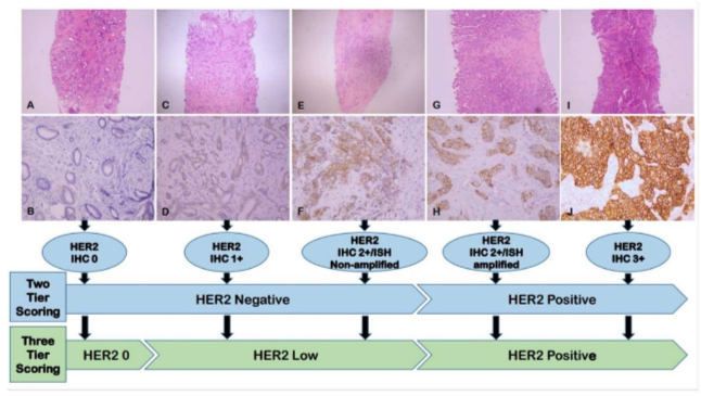 Grafika paradygmatu oceny nadekspresji HER2  na graficznej prezentacji próbek tkanki z różnym stopniem nadekspresji białka.